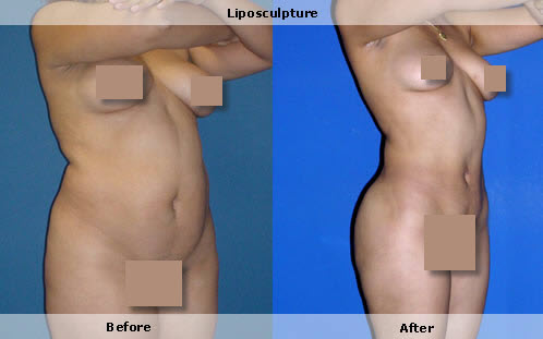liposculpture, with fat grafting to buttocks